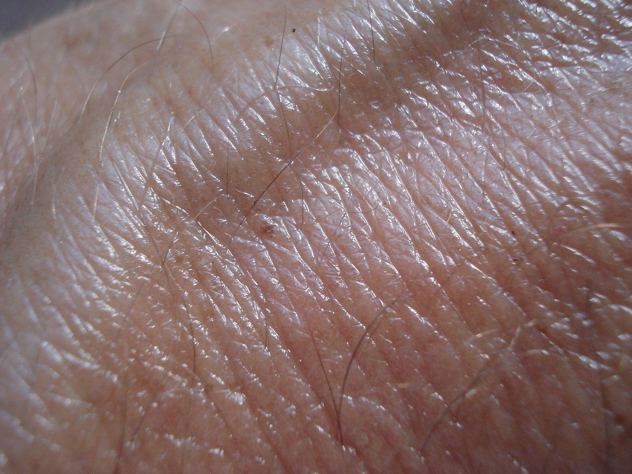 Riskiest skin cancer cases hit UK record high